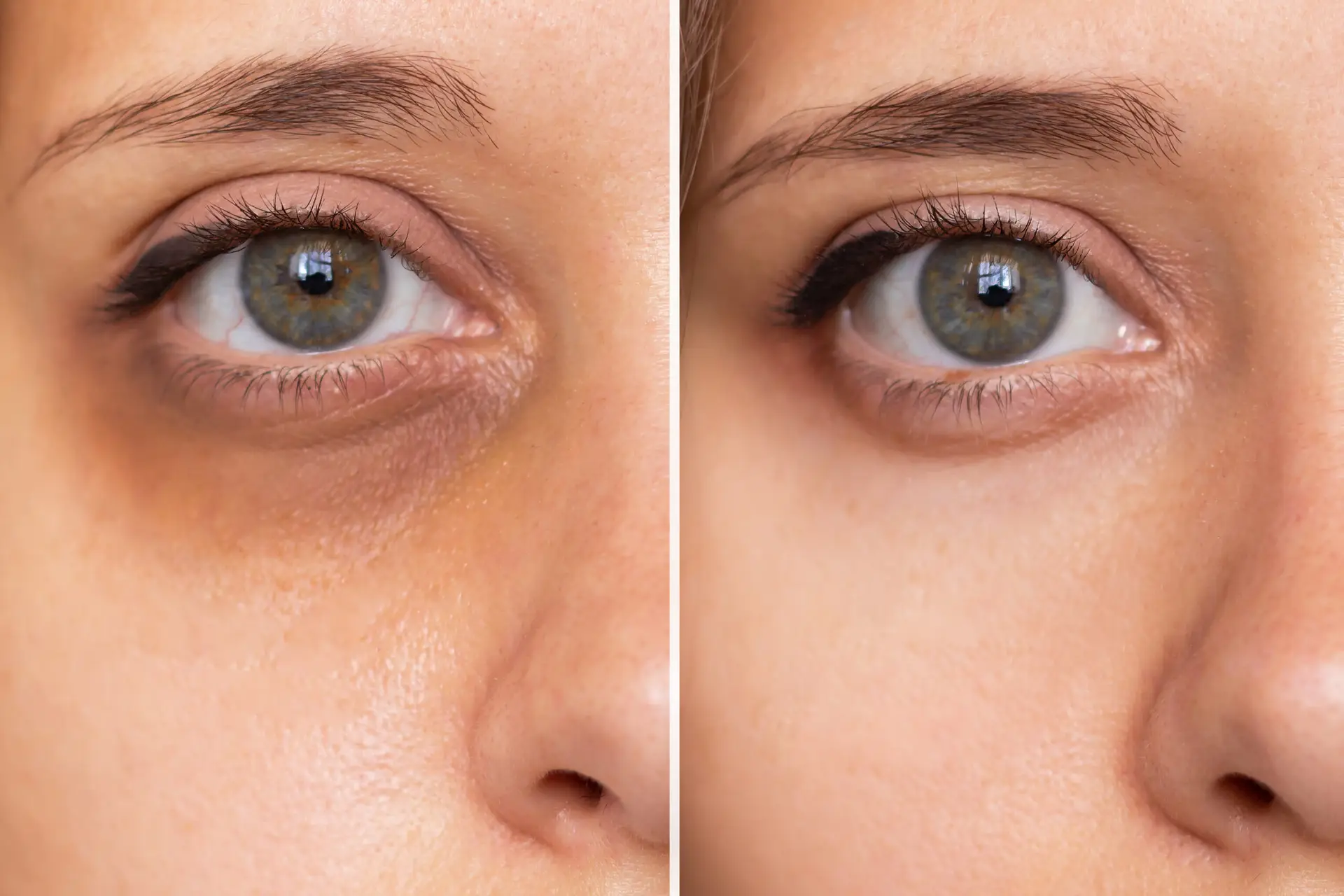 Best eye cream for dark circles